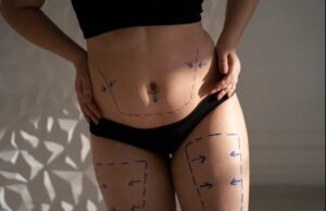 Non surgical thigh lift in mumbai