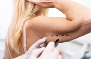 Non Surgical Arm lift in mumbai